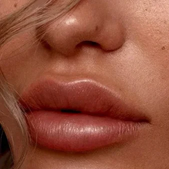 ¿Cómo es el proceso de <em>Aumento de Labios</em>?