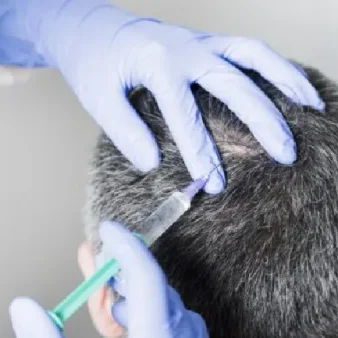 aplicacion mesoterapia capilar