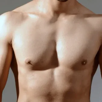 resultado ginecomastia