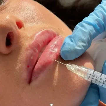 ¿Cómo es el proceso de <em>Aumento de Labios</em>?