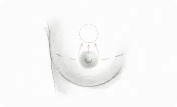 Reposicionamiento de areola y pezón