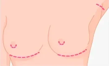 ¿Por que somos el mejor centro de España en Cirugía Estética Mamaria?