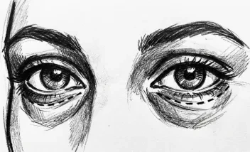 Blefaroplastia inferior