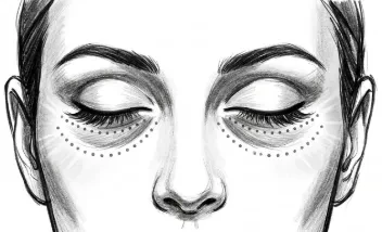 Carboxiterapia TH para ojeras y contorno de ojos