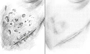Cicatrices de acné y quirúrgicas