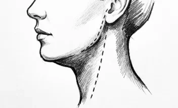 Eliminación de papada con tensado cervical