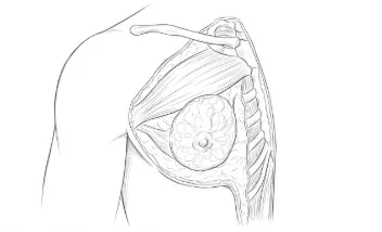 Ginecomastia glandular