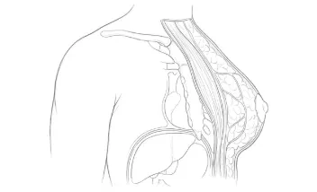 Ginecomastia grasa (liposucción)