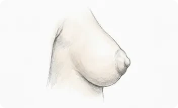 mamas Tuberosa Grado 2