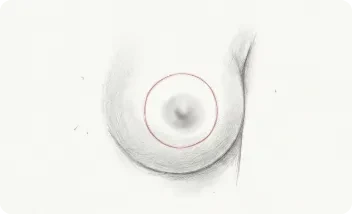 Mastopexia Elevación periareolar (Donut):