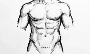 Mini abdominoplastia