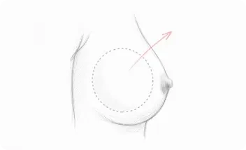 retirada de implantes sin substitución
