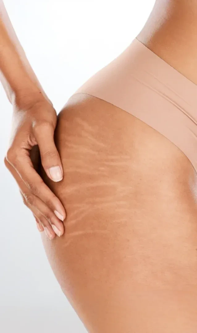 ondas de choque para quitar estrias