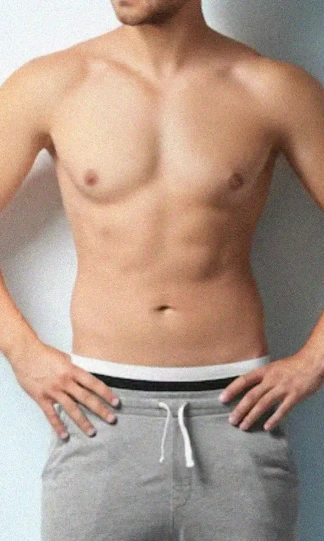 ginecomastia vertical