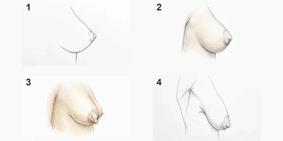 Tuberous breast grades: how to tell which one you have and what surgery each needs