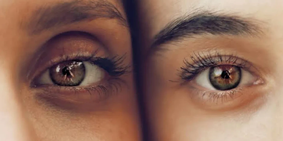 ¿Las ojeras se pueden quitar? 