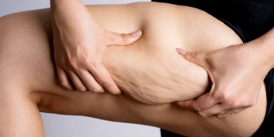 ¿Piernas cansadas sin razón? Podría ser lipedema