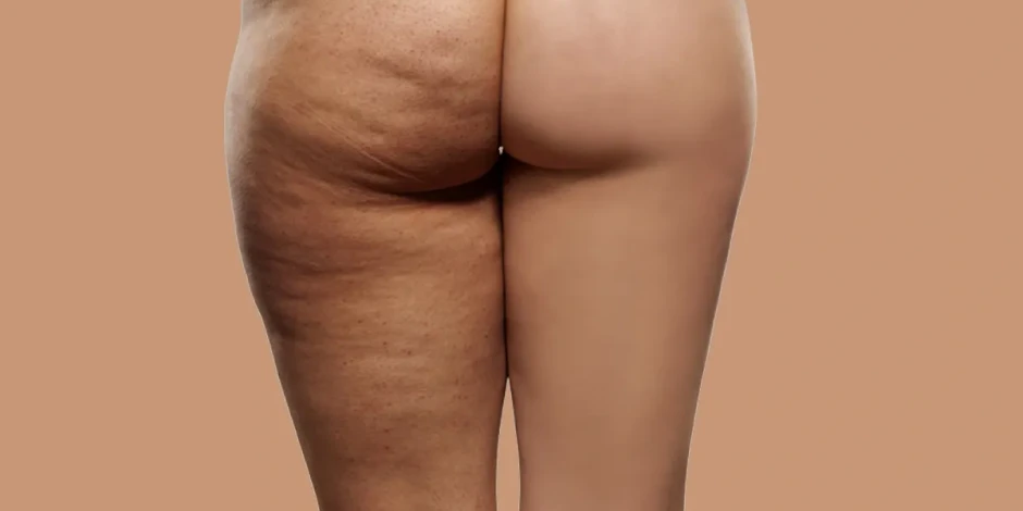 Escoge el mejor plan para la operación bikini