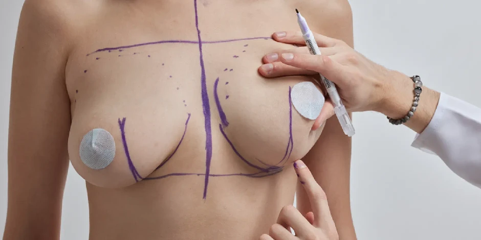 How much does a breast reduction cost in Spain? Price 2026, what's included and factors